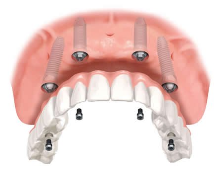 Внутрислизистые зубные импланты