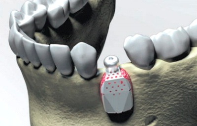Регенерация кости на нижней челюсти